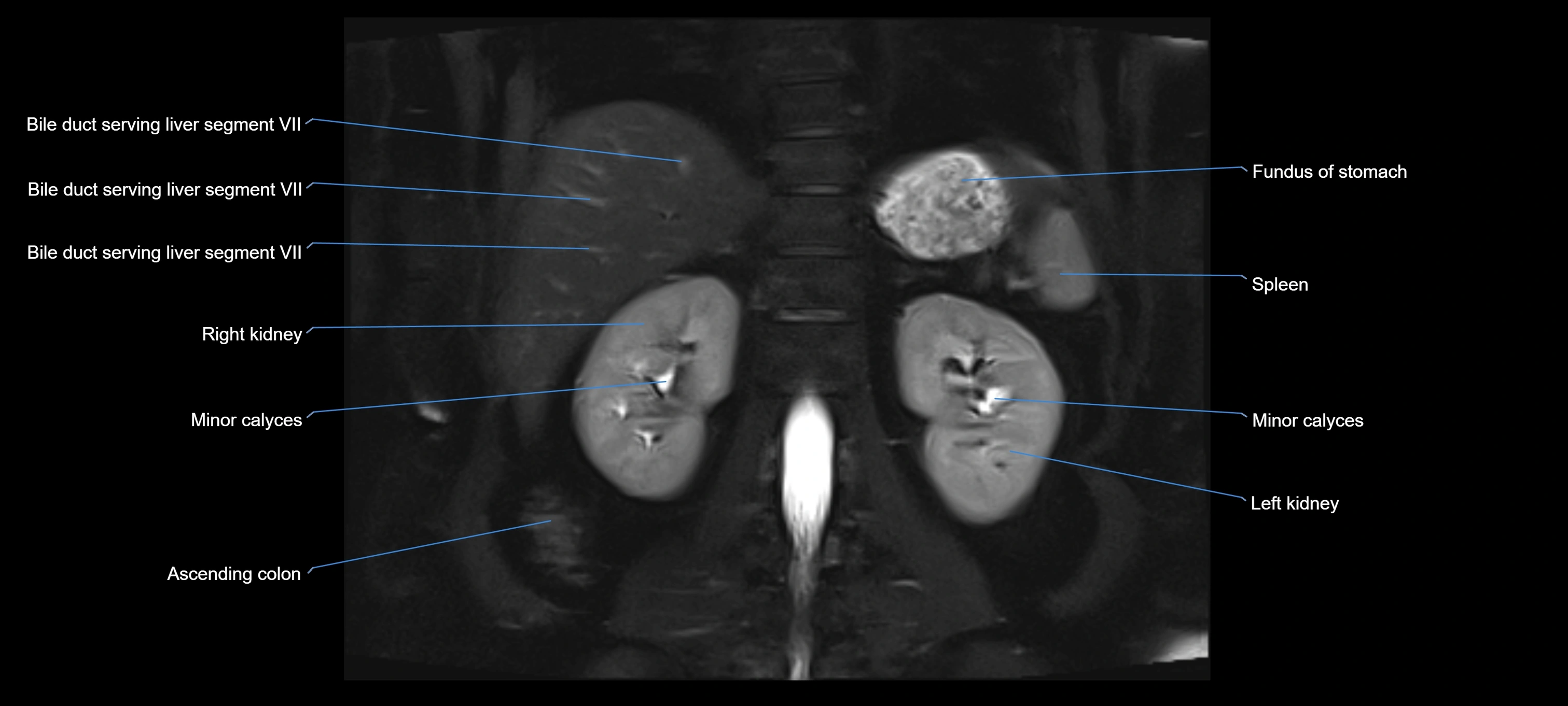 MRI MRCP coronal cross sectional 3T radiology  image-img-00001-00021.webp